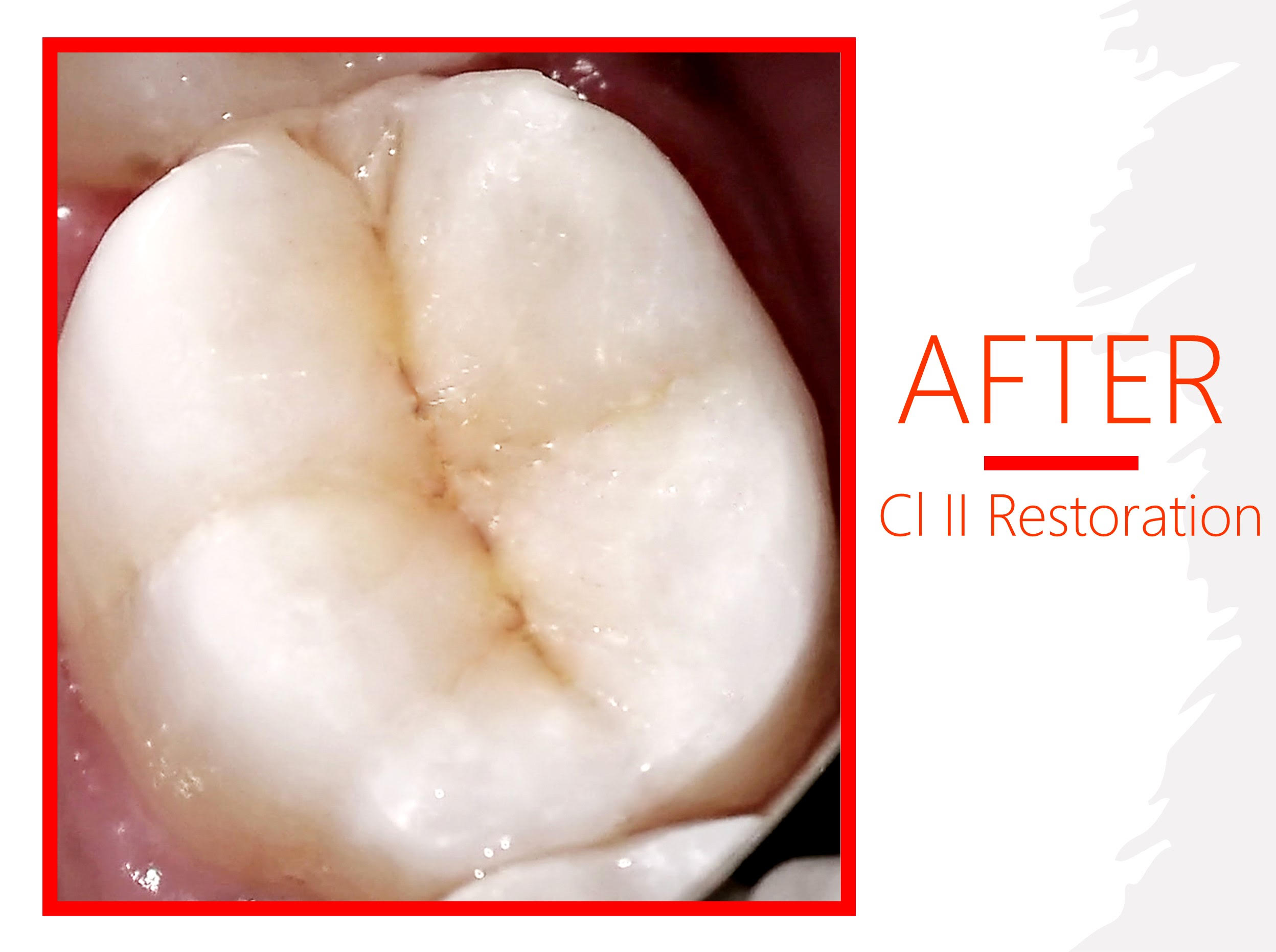 Class II Composite Restoration