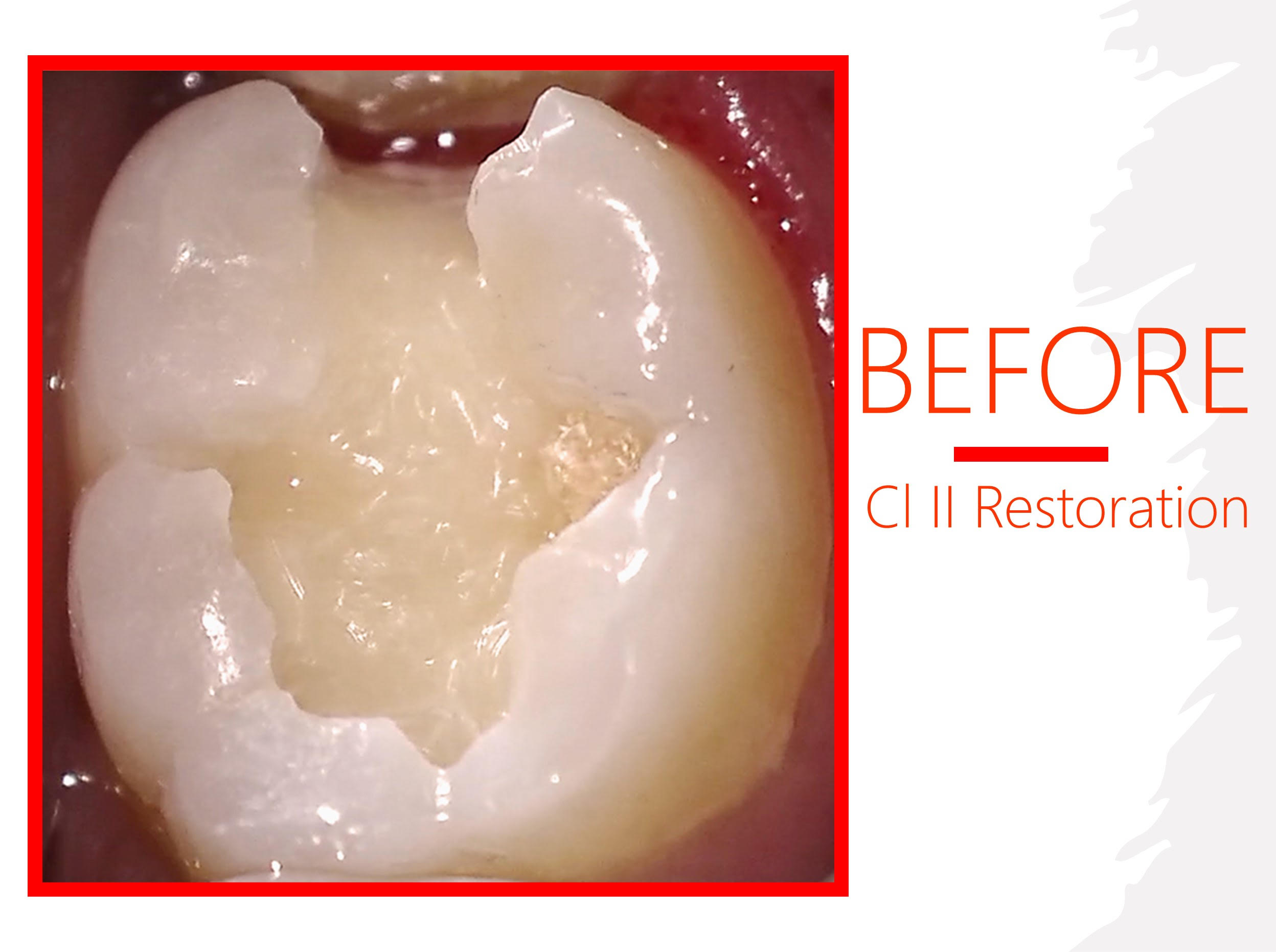 Class II Composite Restoration