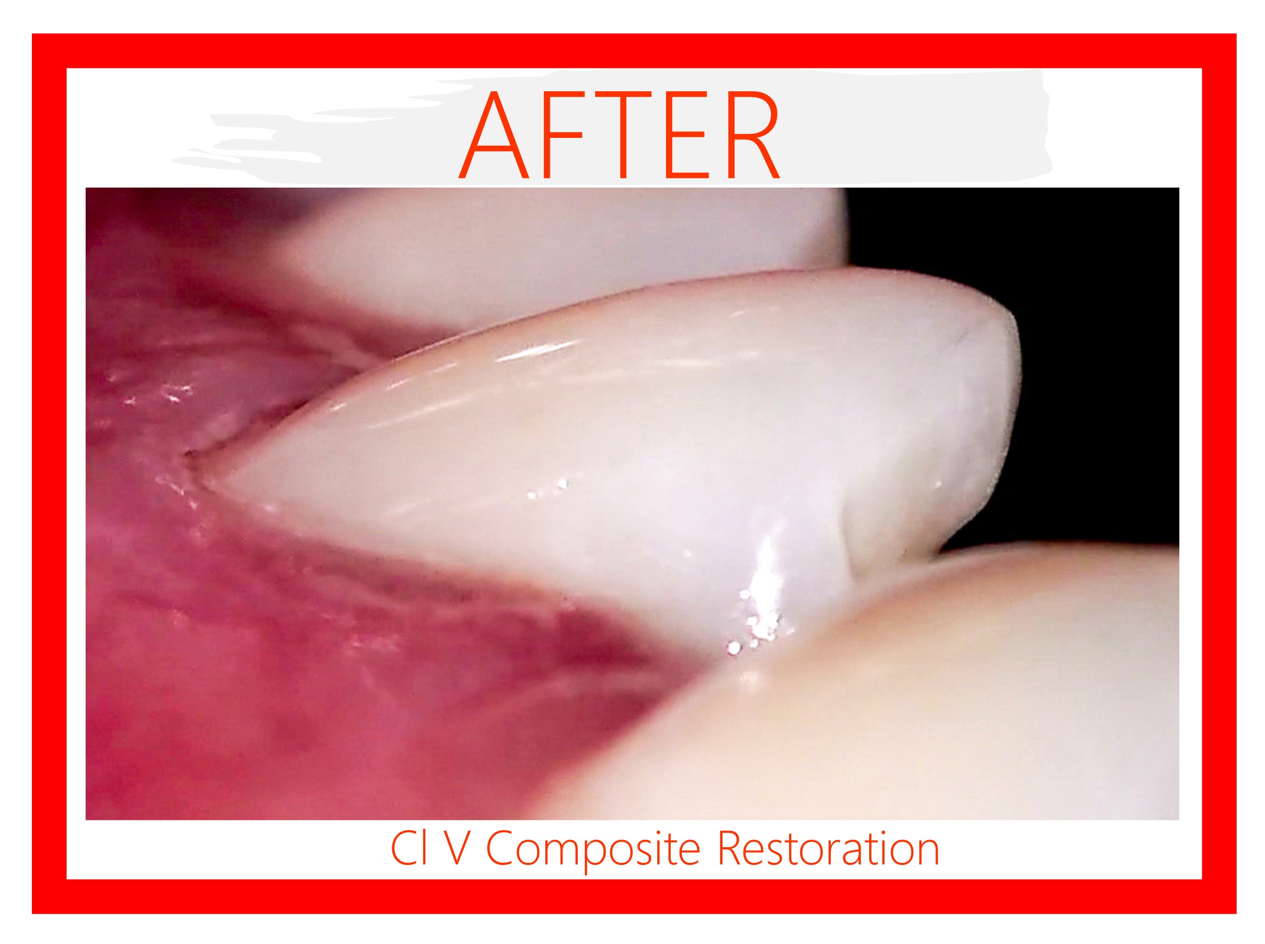Class V Composite Restoration