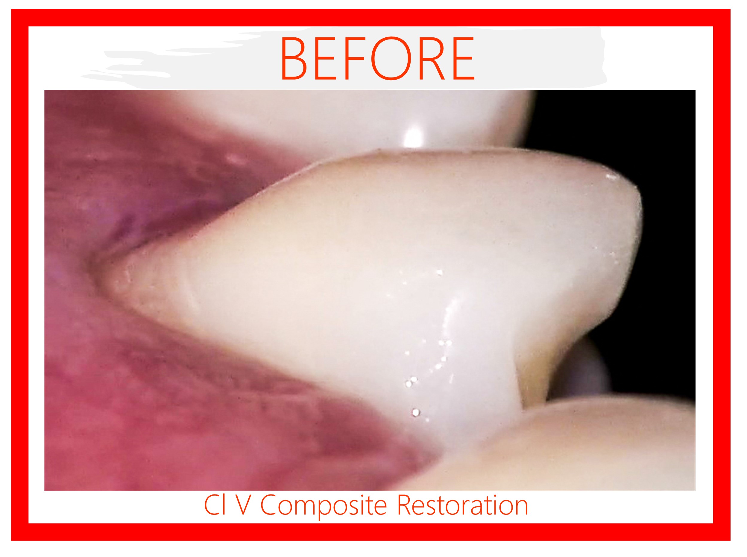 Class V Composite Restoration