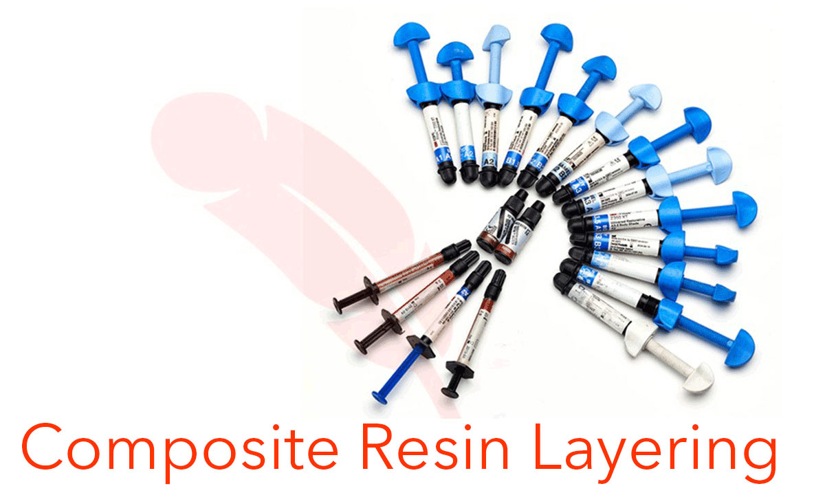 Composite resin layering