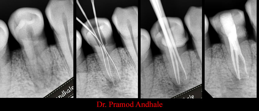 Clinical Cases Anatomical Variation
