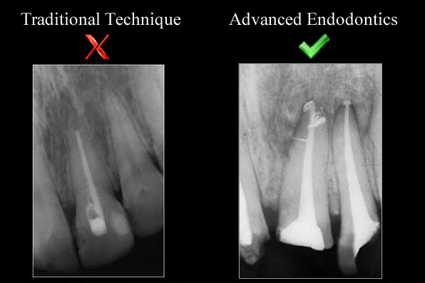 advanced endodontics courses, advanced root canal courses
