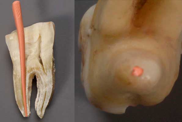 advanced endodontics courses, advanced root canal courses