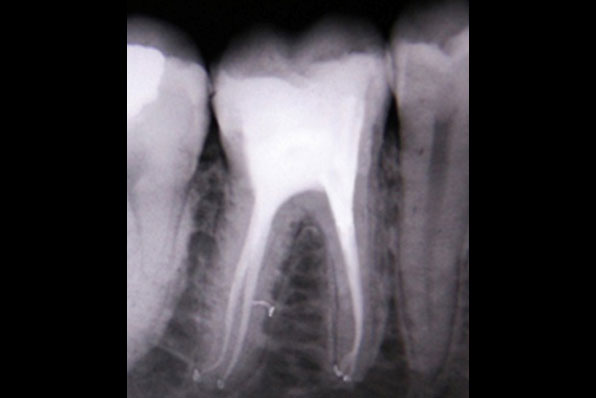 advanced endodontics courses, advanced root canal courses